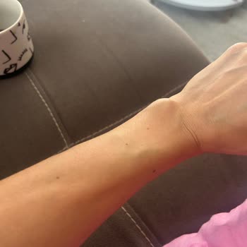 Media Markt’ta Apple Watch İade Reddi Ve Bilek Şişliği