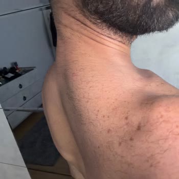 Lazer Epilasyon Sonrası Kıllar Kalınlaştı Ve Yeni Kıllanma Oluştu