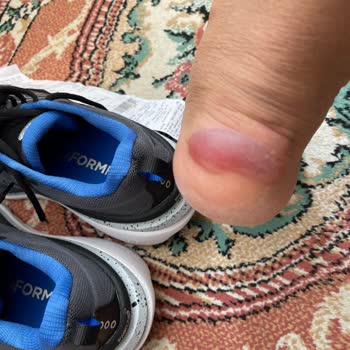 Saucony Hurricane 25 Ayakkabısının Sert Arka Bölümü Nedeniyle Ayak Şişmesi Ve Değişim Şikayeti