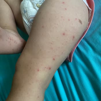Hijyen Sorunu Çocuğumu Hastalığa Sürükledi Ve Tatilimi Kabusa Çevirdi