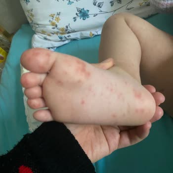 Hijyen Sorunu Çocuğumu Hastalığa Sürükledi Ve Tatilimi Kabusa Çevirdi