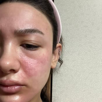 Kiperin Yüz Maskesi Nedeniyle Cilt Yanığı Ve Şişlik, Acil Serviste Tedavi Gerekti