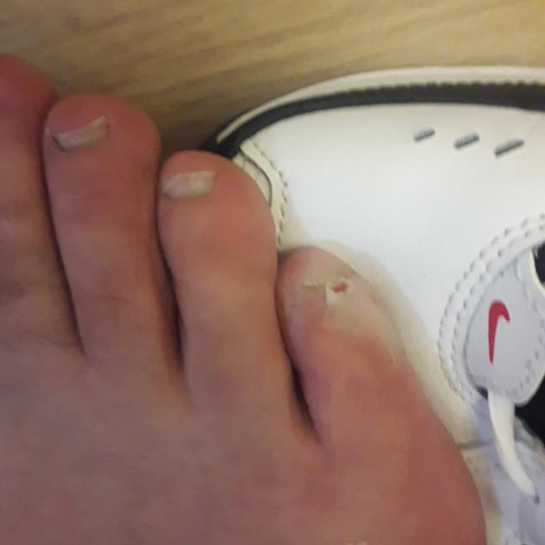 Nike Ayakkabısının Dikiş Çıkıntısı Nedeniyle Ayağım Kanadı, Değişim Talebim Reddedildi