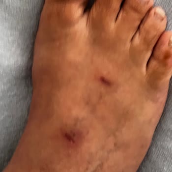 Mersin Forum Hotiç Mağazasında Süet Terlikten Ciddi Ayak Yaralanması Ve İade Talebi