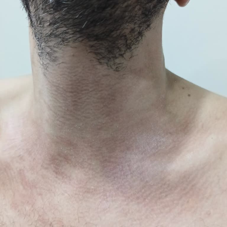 Duru Nem Bombası Şampuanda Alerjik Reaksiyon Yaşama