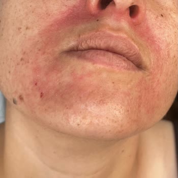 Yves Rocher Ürünleri Nedeniyle Uzun Süreli Cilt Tahrişi Ve Maddi Ve Manevi Mağduriyet
