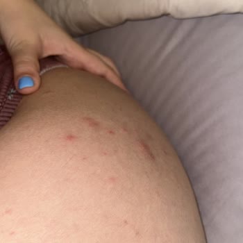 Lazer Epilasyon Sonrası Şiddetli Sivilcelenme Ve Ücret İadesi Talebi