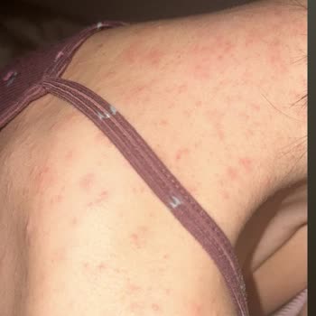 Lazer Epilasyon Sonrası Şiddetli Sivilcelenme Ve Ücret İadesi Talebi