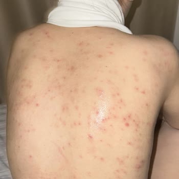 Lazer Epilasyon Sonrası Şiddetli Sivilcelenme Ve Ücret İadesi Talebi