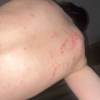 Lazer Epilasyon Sonrası Şiddetli Sivilcelenme Ve Ücret İadesi Talebi