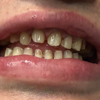 Yıldız İstanbul Diş Kliniği Doğal Dişlerimde Geri Dönüşü Olmayan Zarar Oluştu