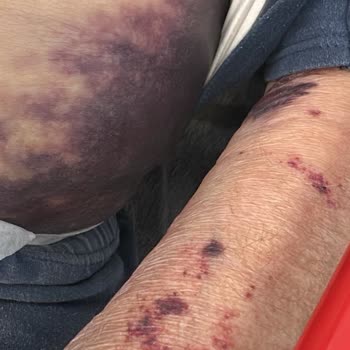 Yoğun Bakım Hastasının Uygunsuz Taburculuğu Ve Düşürülmesi