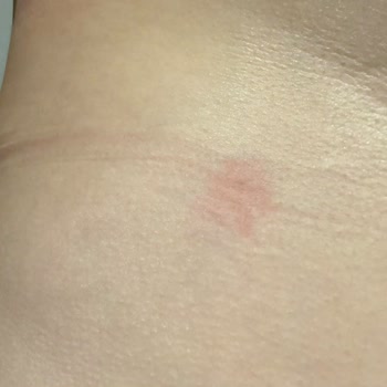 Alerjik Reaksiyonlu Sütyen İadesi Hijyen Nedeniyle Reddedildi