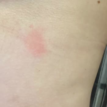 Alerjik Reaksiyonlu Sütyen İadesi Hijyen Nedeniyle Reddedildi