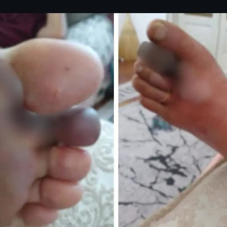 Muğla Ve Milas Hastanelerinde Acil Tedavi Engeli Ve Hayati Risk