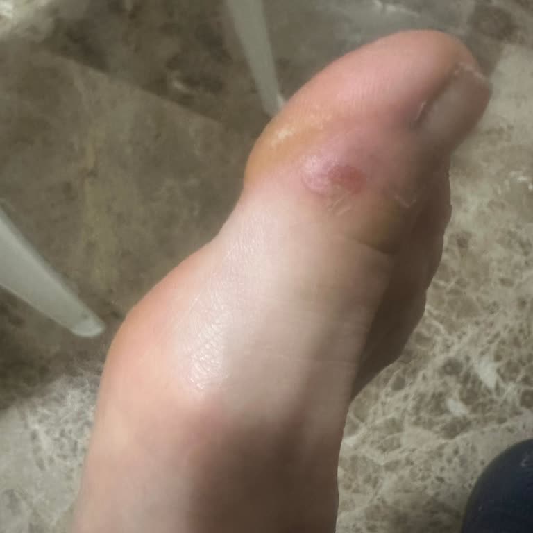 Derimod Sandaletiyle Cilt Tahrişi Ve İade Sürecinde Gecikme