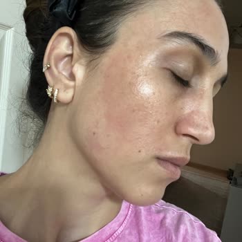 Yanlış Sipariş Ve Zorunlu Kullanım Sonrası Cilt Reaksiyonu İle İade Sorunu