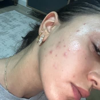 Bioderma Ürünlerinden Şiddetli Cilt Reaksiyonu Ve İade Talebi