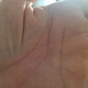 Velavit Ceramid Ve Dim Ürünlerinde Şiddetli Kaşıntı Ve Kabarcık Şikayeti
