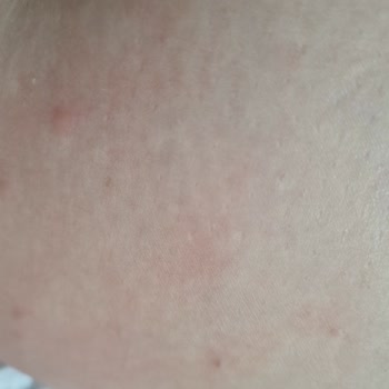 Velavit Ceramid Ve Dim Ürünlerinde Şiddetli Kaşıntı Ve Kabarcık Şikayeti