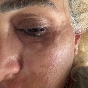 Işıltı Güzellik Merkezi Somon DNA İşlemini Yetkisiz Kişiler Yaptı
