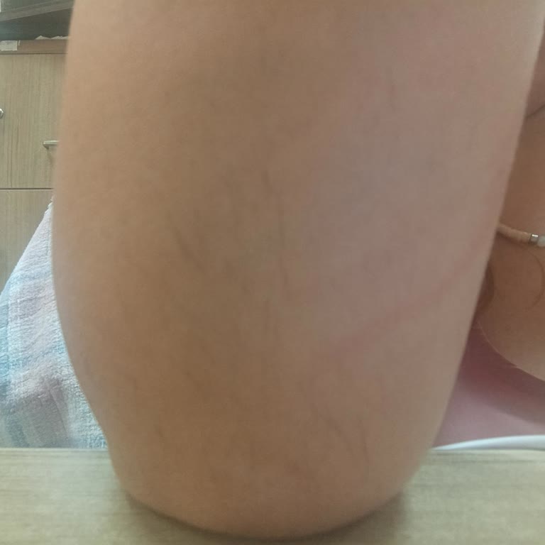 Bronzluk Nedeniyle Seansların İptali Ve Yetersiz Lazer Sonuçları
