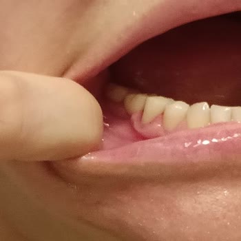 Zürih Diş Kliniği’nde Hatalı Tedavi ve Şiddetli Darp