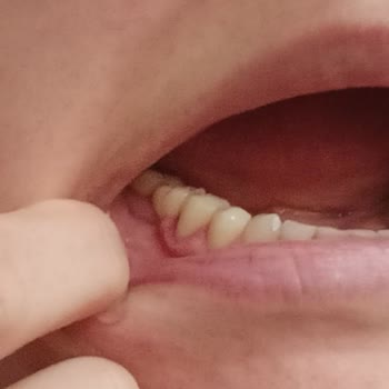 Zürih Diş Kliniği’nde Hatalı Tedavi ve Şiddetli Darp