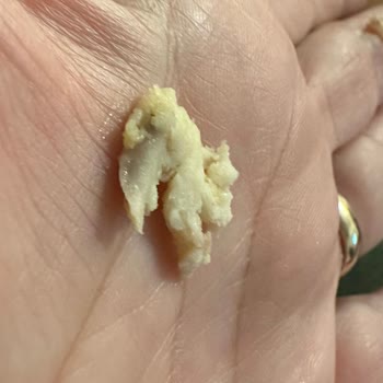 Burger King Hamburgerinde Kemik Bulunması Ve Tam İade Talebi