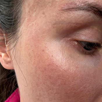 P****** Klinik’te Burun Ameliyatı Sonrası Küçülmüş Burun, Nefes Problemi Ve Şeffaflık Eksikliği