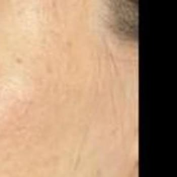 P****** Klinik’te Burun Ameliyatı Sonrası Küçülmüş Burun, Nefes Problemi Ve Şeffaflık Eksikliği
