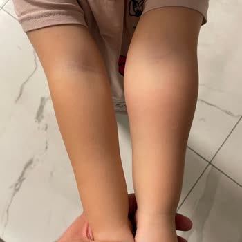 Acil Bölümde Bebek Hemşiresi Yokluğu Ve Tekrarlayan Damar Açma Hataları Çocuğu Mağdur Etti