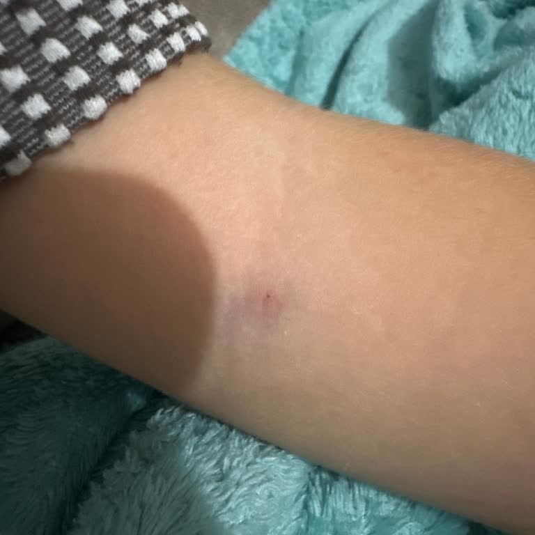 Kelebek İğnesi Olmadan Kan Alma Çocuğumu Yanmasına Ve Morarmasına Neden Oldu