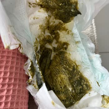 Aptamil Prosyneo Bebek Maması Şiddetli İshal Ve Kusma Nedeniyle İade Talebi