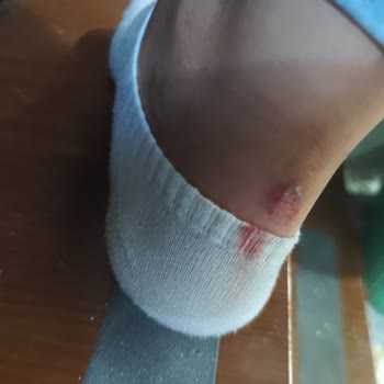 Sünger Olmayan Topuklu Ayakkabıda Deri Soyulması Ve Çorap Yırtılması