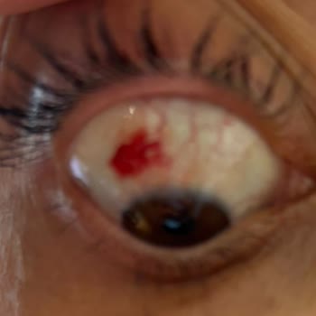 Hatalı Dolgu Ve Botoks Müdahaleleri Sonucu Göz Ve Burun Bozuklukları Ve 38 Bin TL İade Talebi