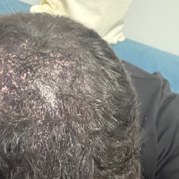 Vaat Edilen 5 Gün Kalıcılık Sağlanmadı, Saç Derisinde Kabuklu Dökülme