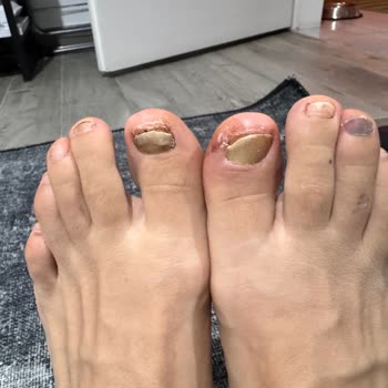 20 Bin TL'lik Hoka Trail Ayakkabısının İlk Kullanımda Yırtılması Ve Sağlık Zedelenmesi