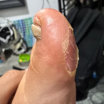 20 Bin TL'lik Hoka Trail Ayakkabısının İlk Kullanımda Yırtılması Ve Sağlık Zedelenmesi