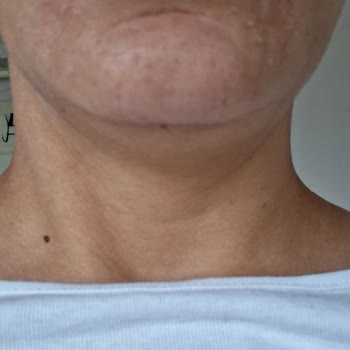 Watsons PH Lab Cilt Bakım Ampulü Sonrası Kaşıntı Ve Kızarıklık, Şirketin Empatisiz Yanıtı