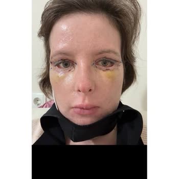 Op. Dr. Veli Gündüz Göz Kapağı Estetik Ameliyatında Sağlığımı Bozdu