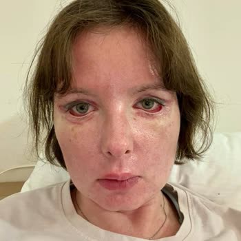 Op. Dr. Veli Gündüz Göz Kapağı Estetik Ameliyatında Sağlığımı Bozdu