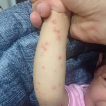 Setur'un Hijyen İhmali Nedeniyle Çocuğumuzun Hastalanması Ve İade Reddi