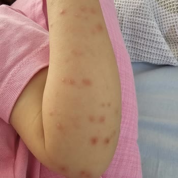 Setur'un Hijyen İhmali Nedeniyle Çocuğumuzun Hastalanması Ve İade Reddi