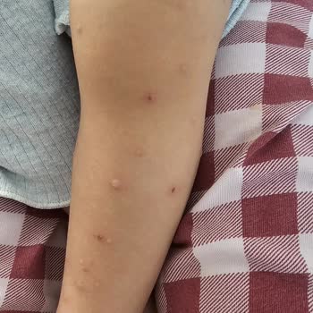 Setur'un Hijyen İhmali Nedeniyle Çocuğumuzun Hastalanması Ve İade Reddi