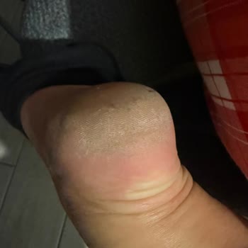 Masaj Ve Manikürde Hatalı Uygulama, Kesikler Ve İade Talebi
