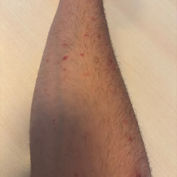 Veet Professional Kremi Kullanım Sonrası Şiddetli Cilt Tahrişi Ve Kalıcı Lekeler