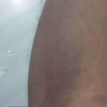Türk Kızılay Kan Verme Sonrası Şiddetli Morarma