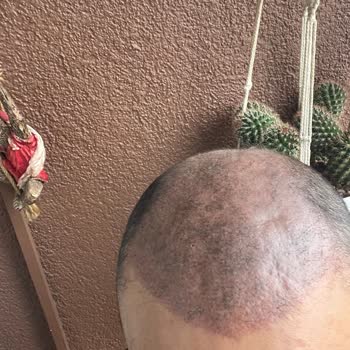 Saç Simülasyonu Sonrası Kalıcı Kızarıklık Ve Yanıltıcı Bilgilendirme
