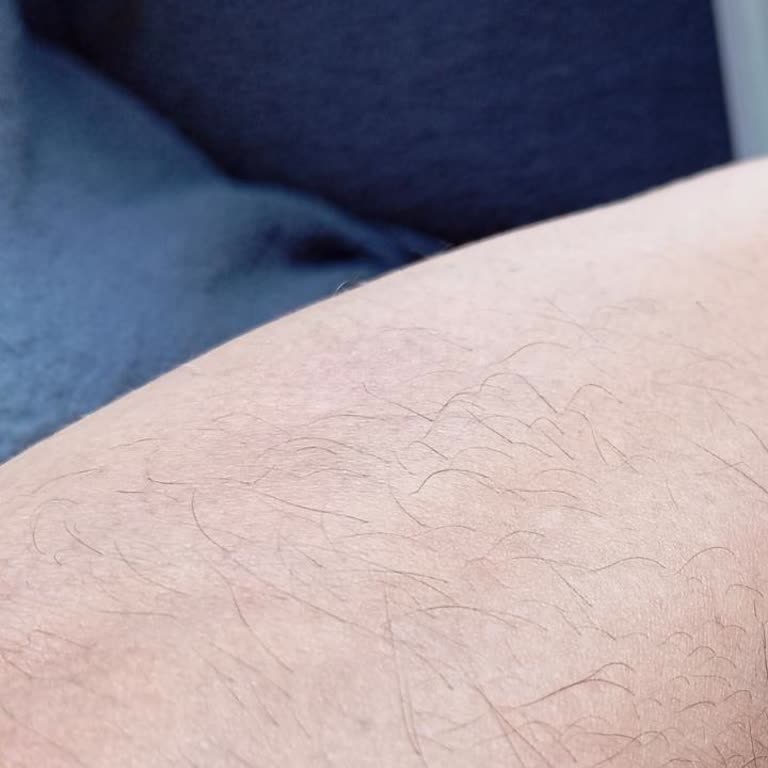 Lazer epilasyon hizmetiyle ilgili şikayet